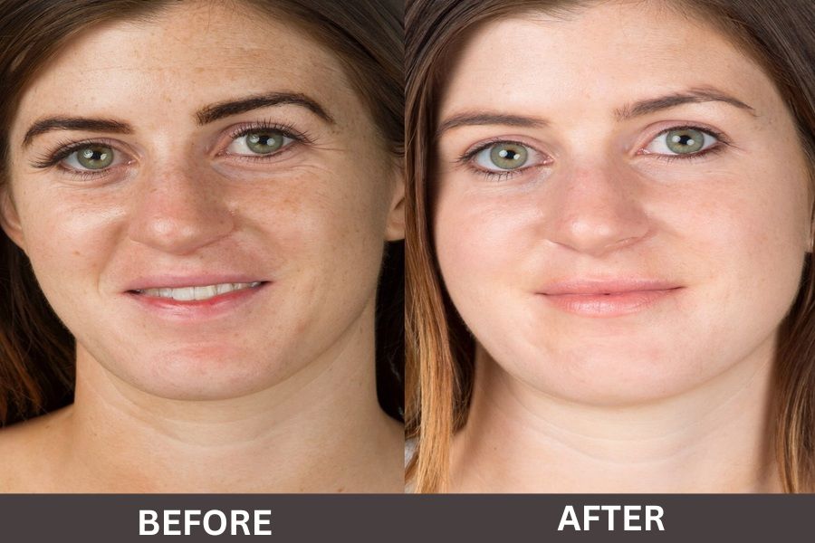 Laser Hair Removal Before and After